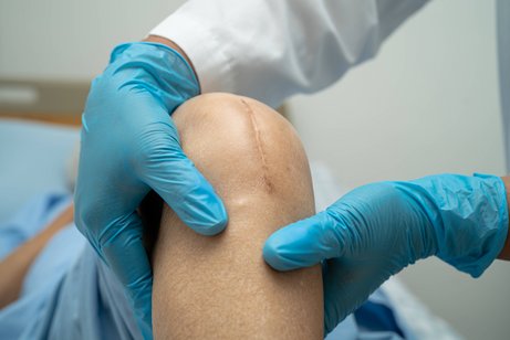 Untersuchung des Knies Ein Arzt oder eine Ärztin mit blauen Handschuhen untersuchen das Knie einer Patientin. Auf dem Knie sieht man eine große Narbe von einer Kniegelenks-Operation.