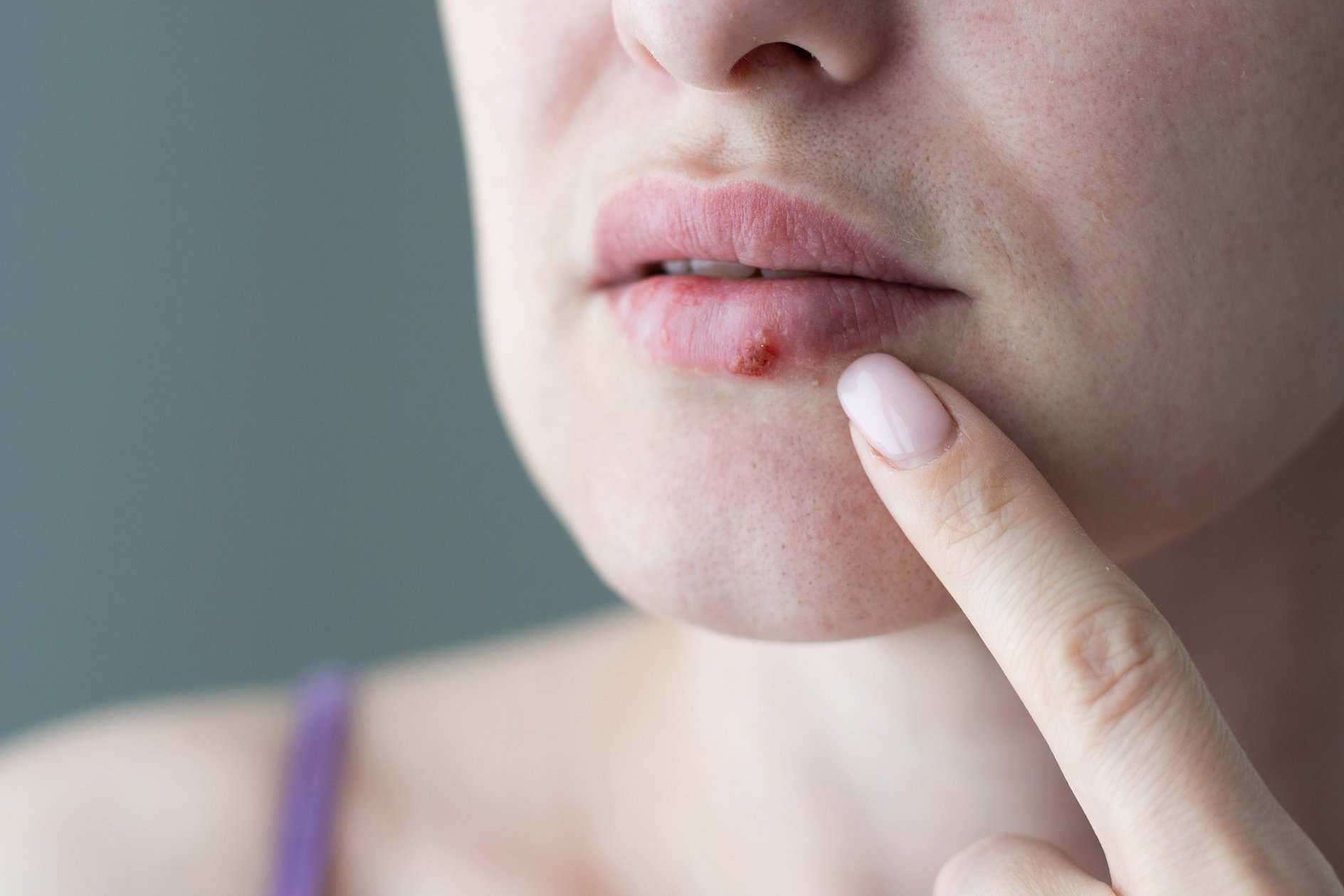Lippenherpes Lippenbläschen Schmerzen Schutz Nahaufnahme eines weibliches Gesichts, auf der Lippe ist ein rotes Lippenbläschen zu sehen, ein Finger fährt in Richtung des Bläschens.