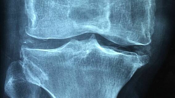 Ein Röntgenbild eines Kniegelenks