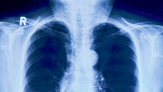 Röntgenbild der Lungen